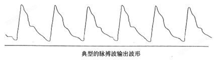 脉搏的典型压力波形，可以用于病理性分析
